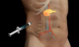 胰岛素注射视频教程,轻松掌握注射技巧与注意事项